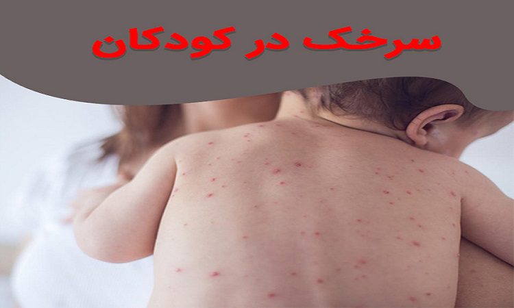 سرخک در کودکان و بزرگسالان کد21